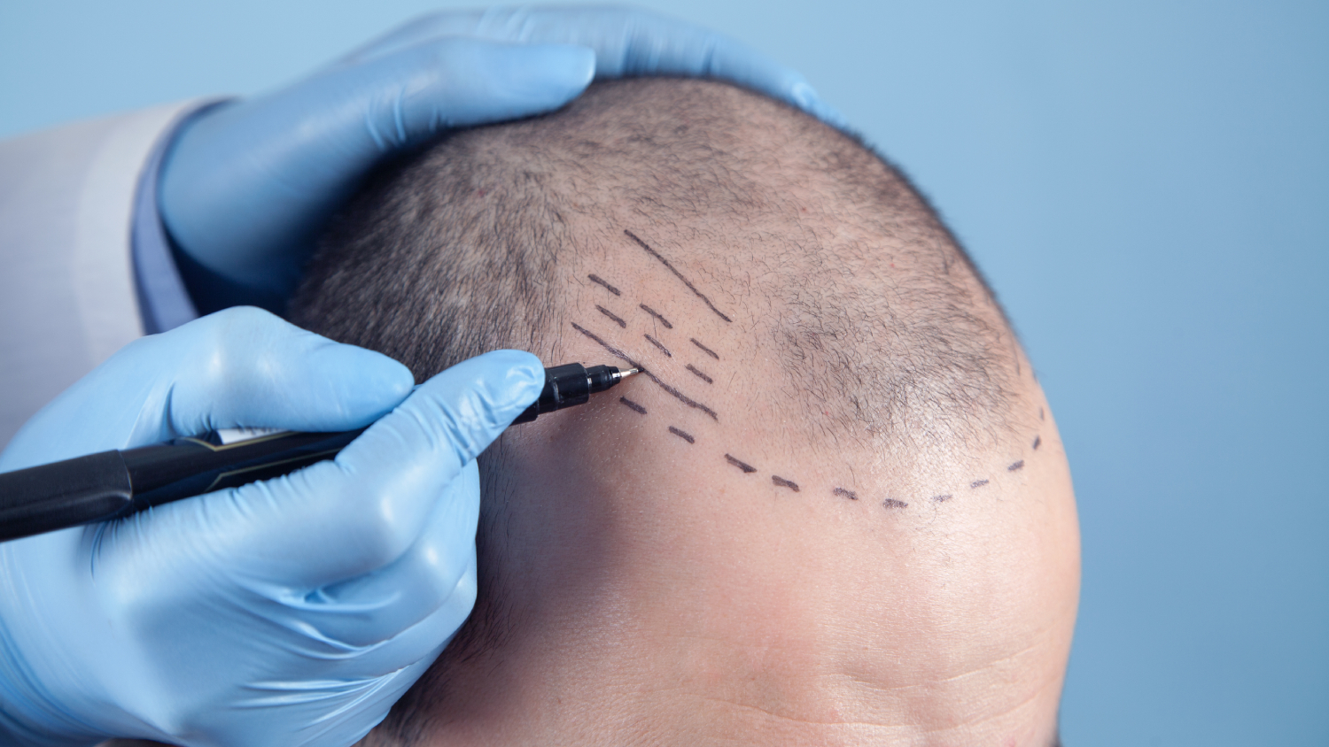 Body Hair Transplantation: Redefine Your Look background
