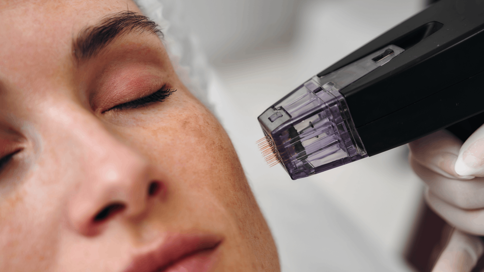 Gold Needle Therapy: Revitalize Your Glow background