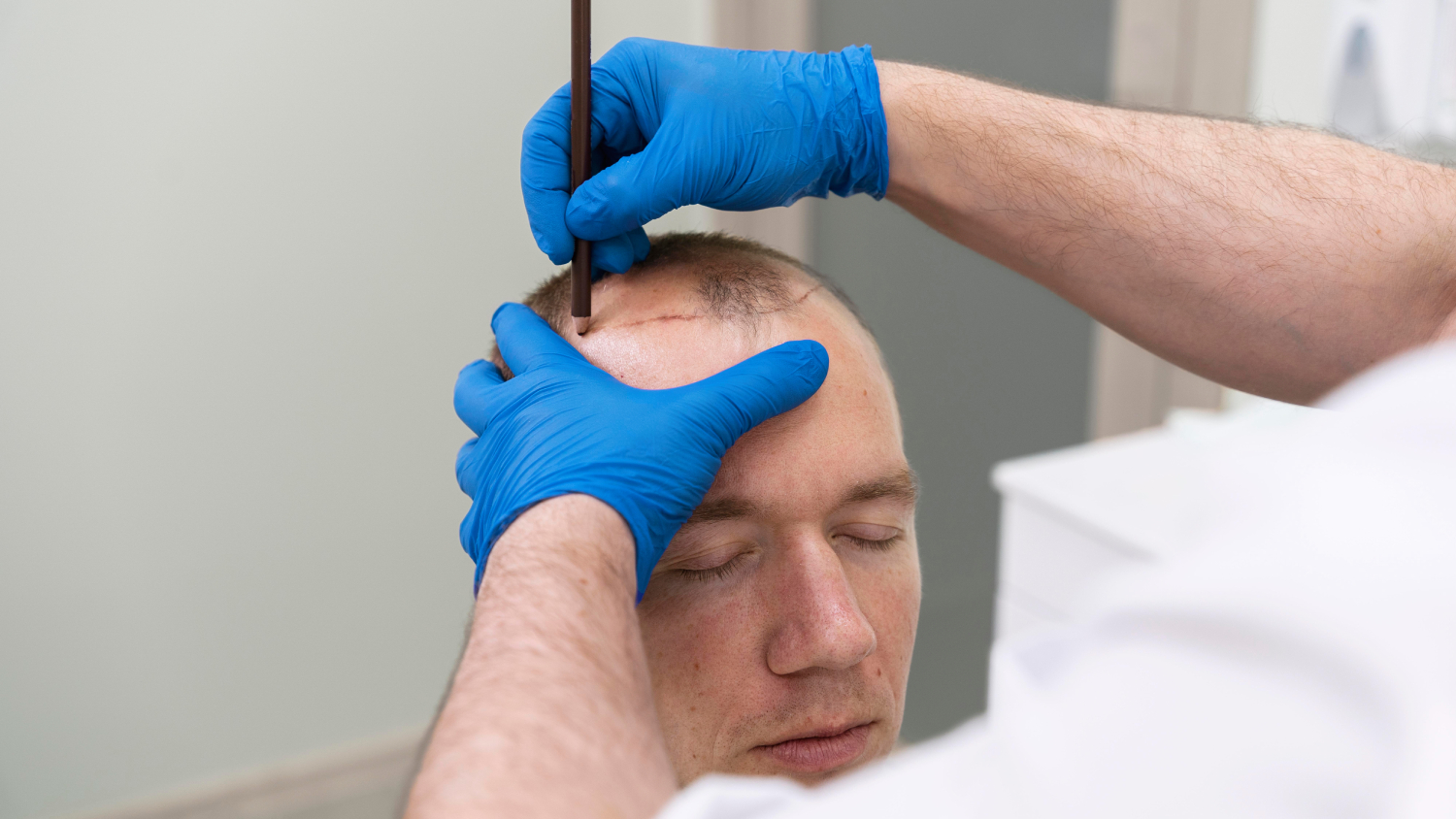 SDHI Hair Transplantation: Restore Fuller Hair background