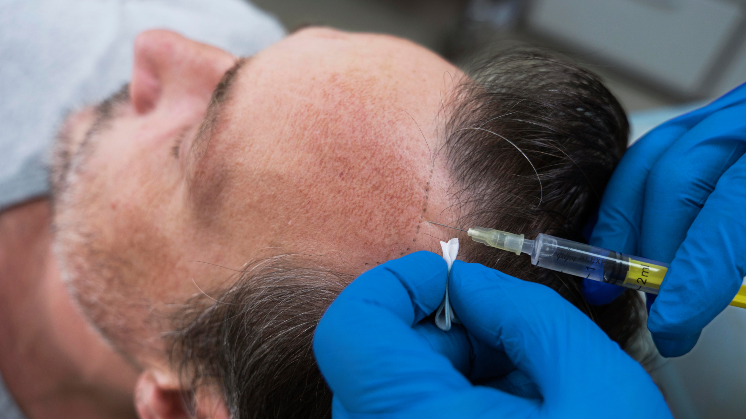 Shaven Hair Transplantation: Renew Your Roots background