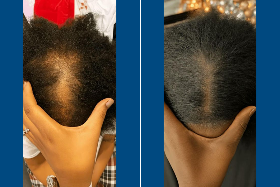 Afro-Hair FUE Transplantation: Embrace Your Roots