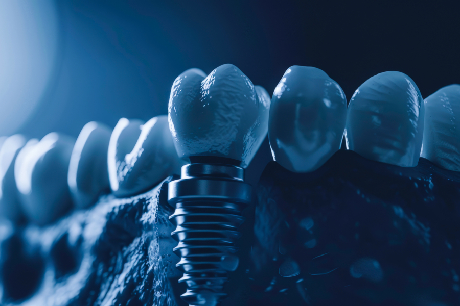 All-on-4 Dental Implants 5