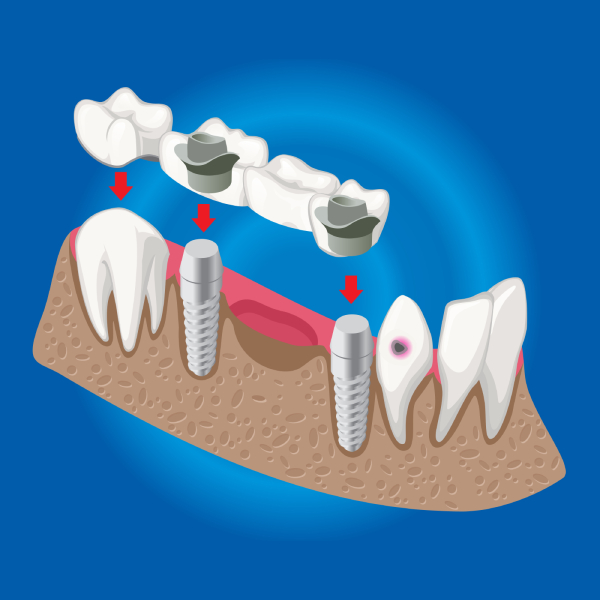 All-on-6 Dental Implants