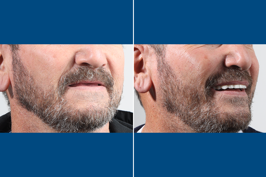 All-on-6 Dental Implants 2