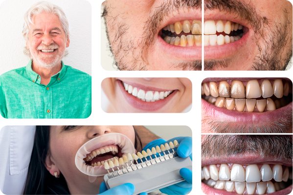 All-on-6 Dental Implants