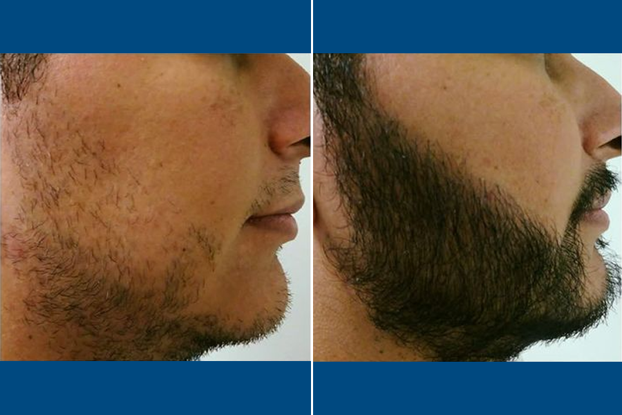 Beard Transplantation: Frame Your Face