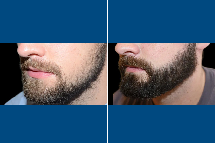 Beard Transplantation: Frame Your Face