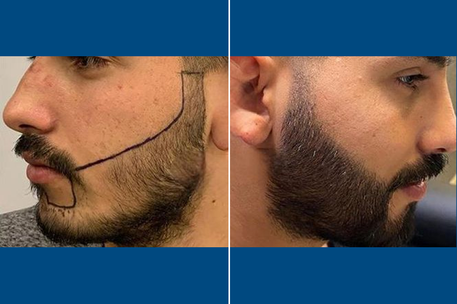Beard Transplantation: Frame Your Face