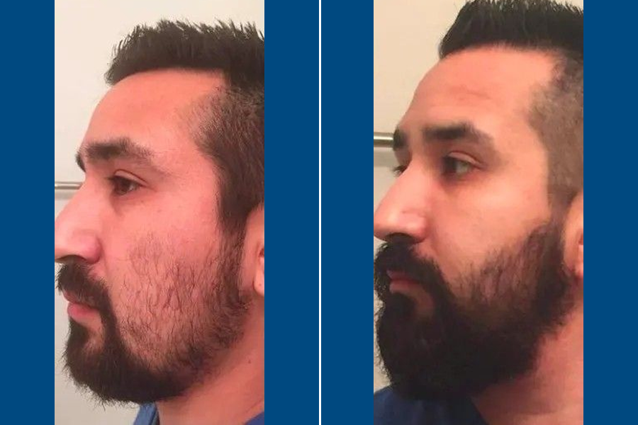 Beard Transplantation: Frame Your Face