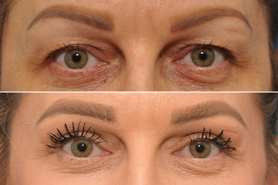 Blepharoplasty