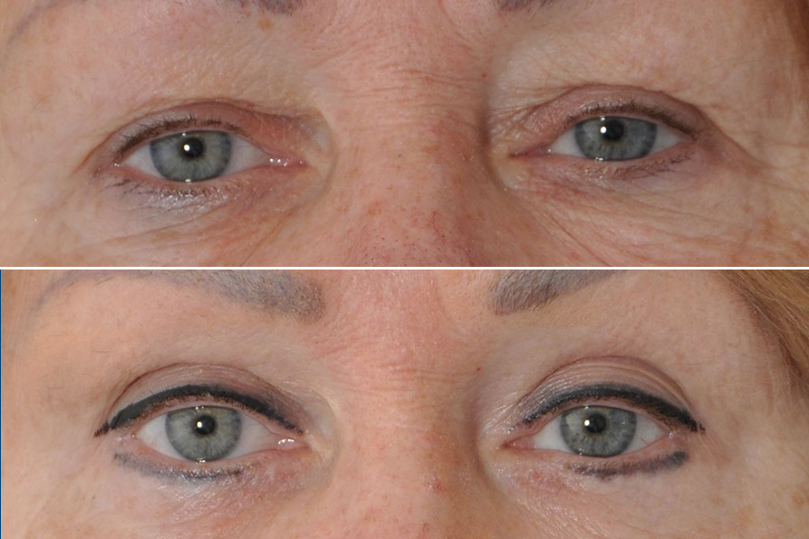 Blepharoplasty