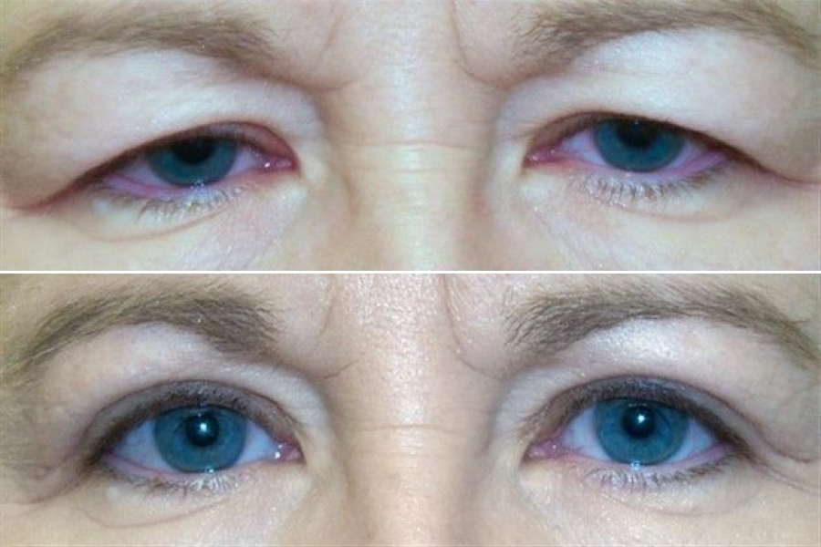 Blepharoplasty