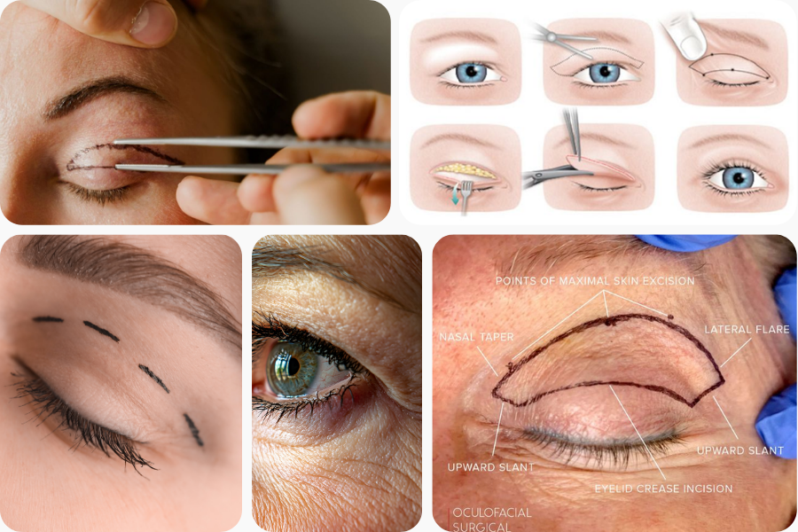 Blepharoplasty