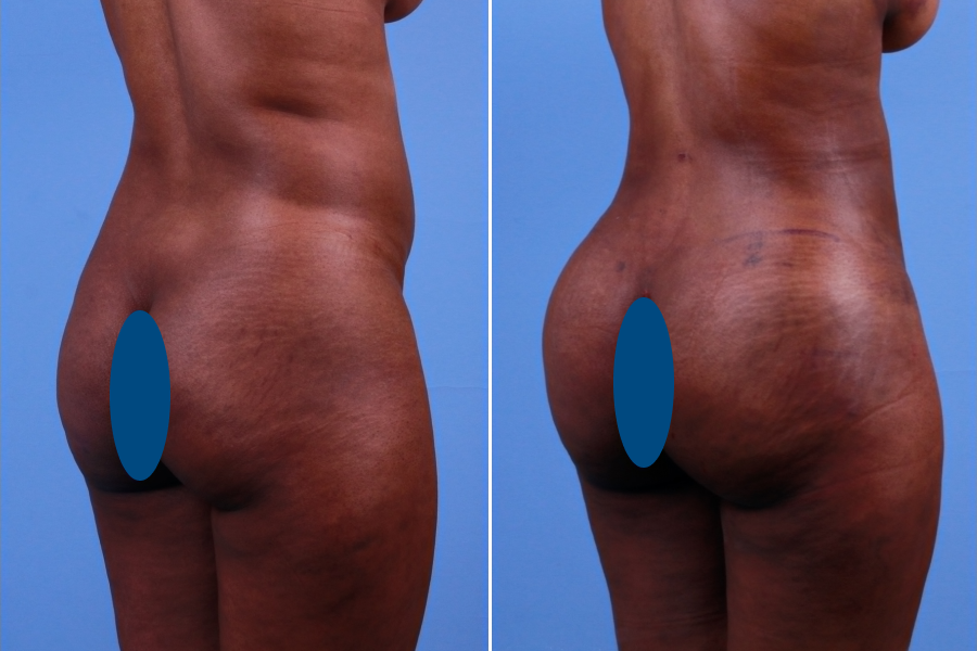 Brazilian Butt Lift (BBL) 3