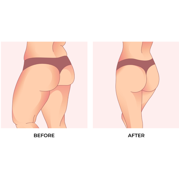 Brazilian Butt Lift (BBL)