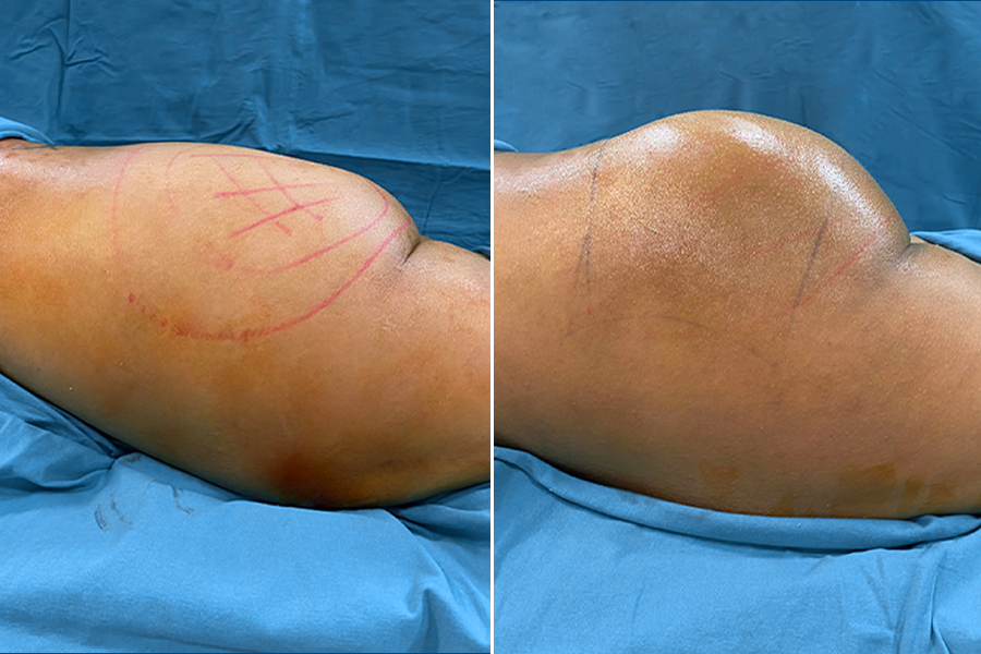 Brazilian Butt Lift (BBL) 5