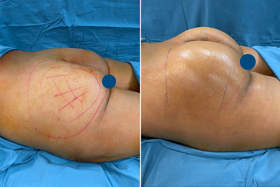 Brazilian Butt Lift (BBL) 1