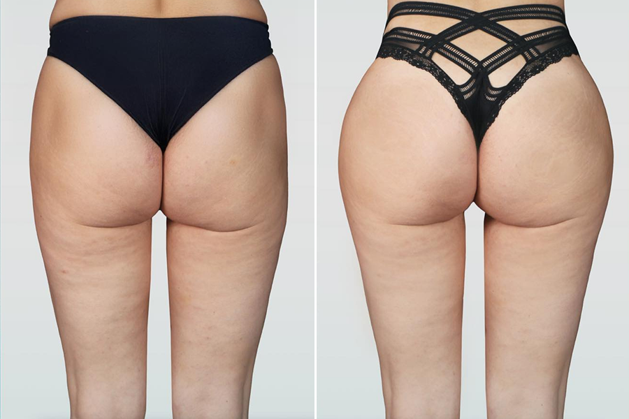 Brazilian Butt Lift (BBL) 2