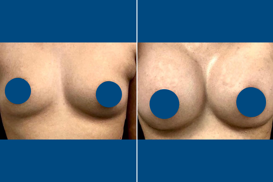 Breast Augmentation 2