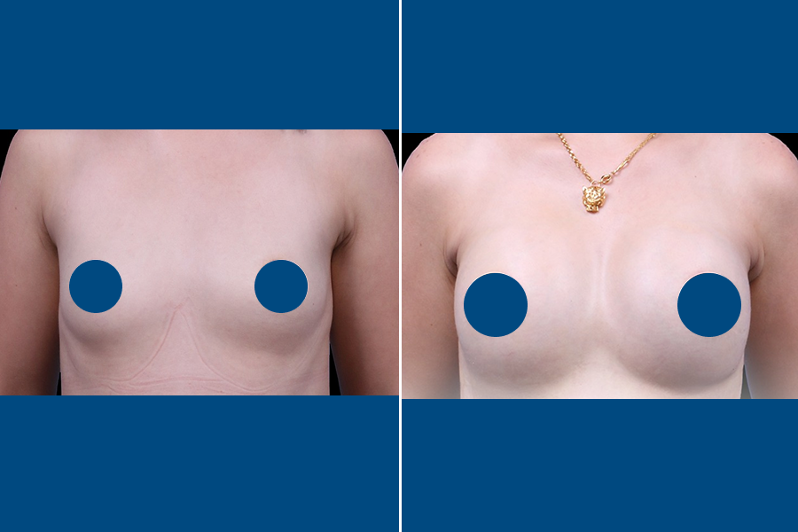 Breast Augmentation 4