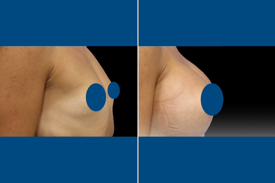 Breast Augmentation 5