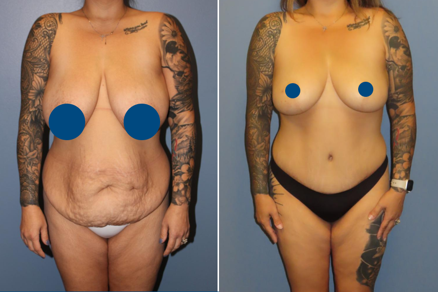 Breast Lift 2