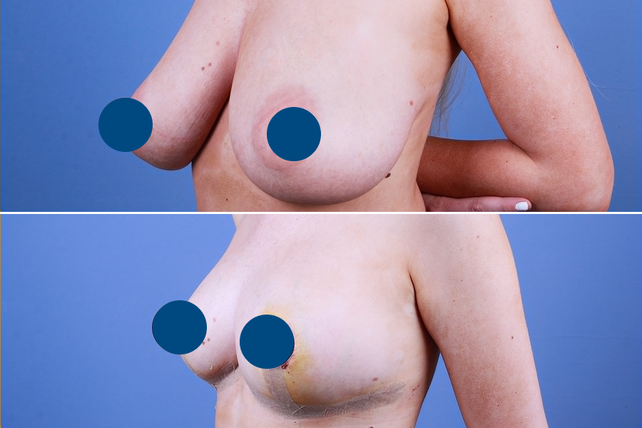 Breast Lift 1
