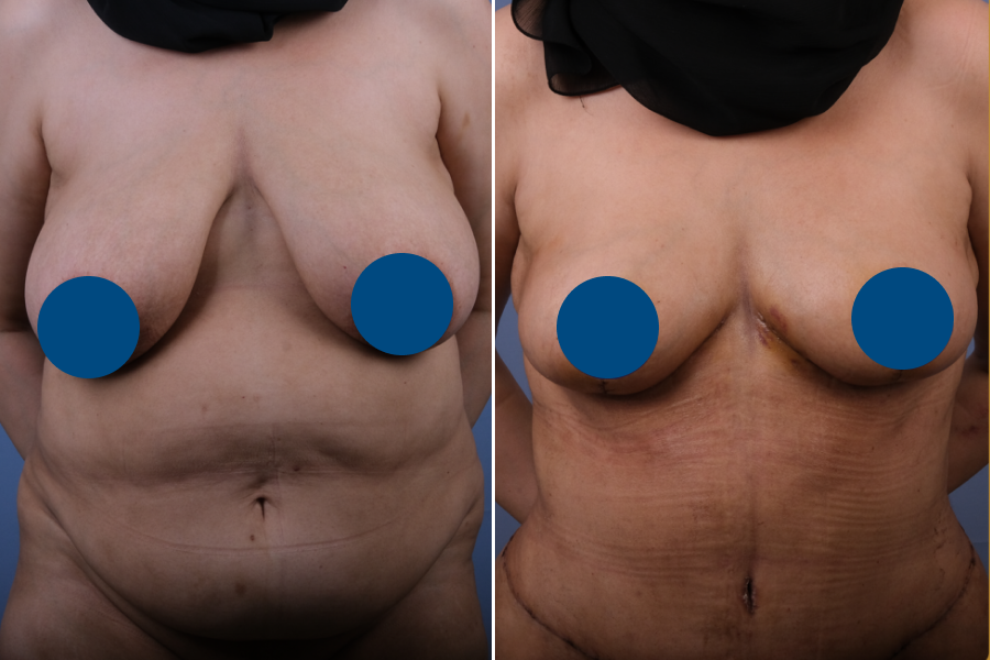 Breast Reduction