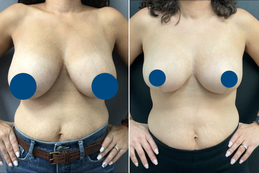 Breast Reduction