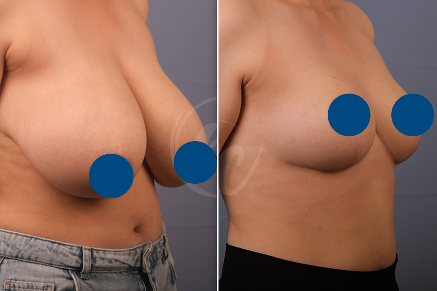 Breast Reduction