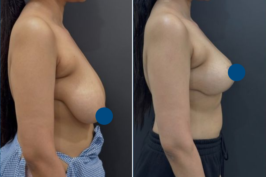 Breast Reduction