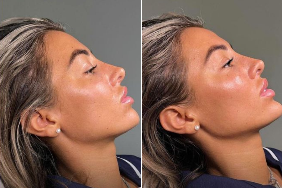 Cheek Augmentation