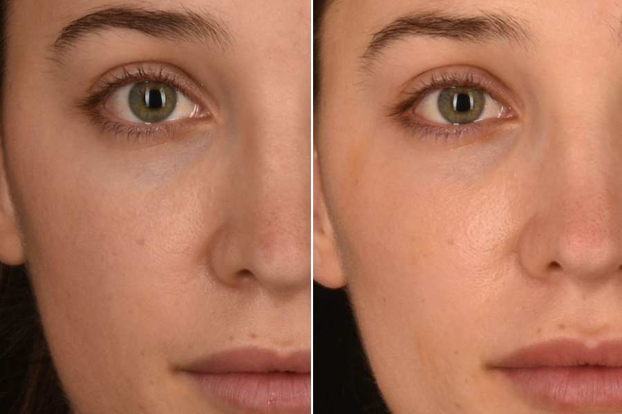 Cheek Augmentation