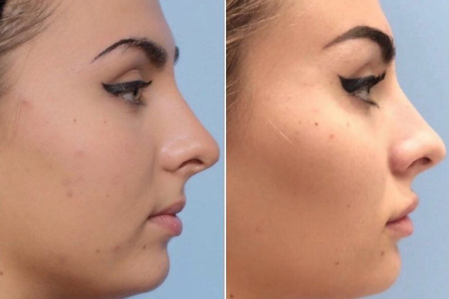 Cheek Augmentation