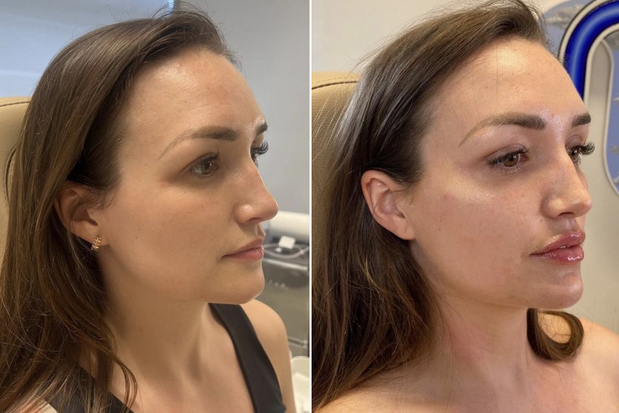 Cheek Augmentation