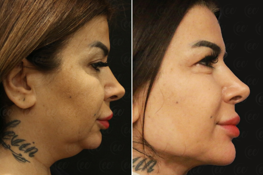 Chin & Jawline Contouring