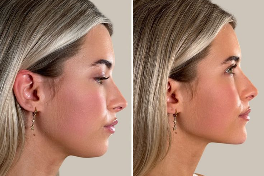 Chin & Jawline Contouring