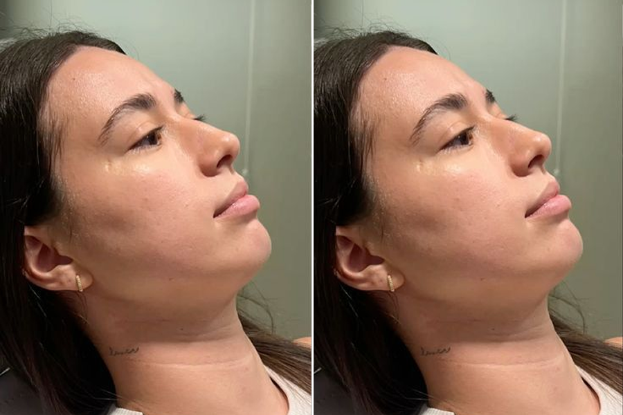Chin & Jawline Contouring