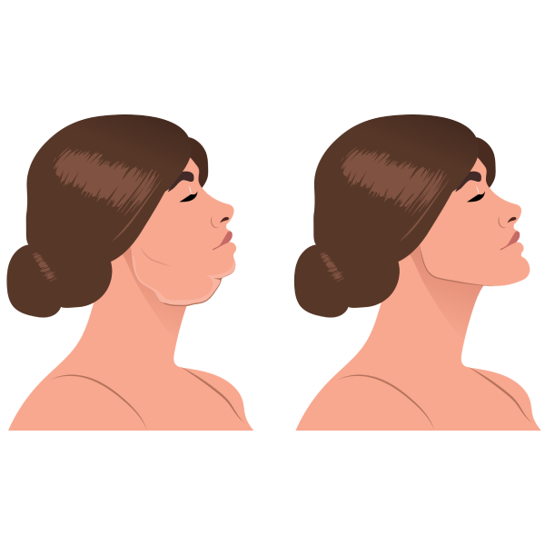 Chin & Jawline Contouring