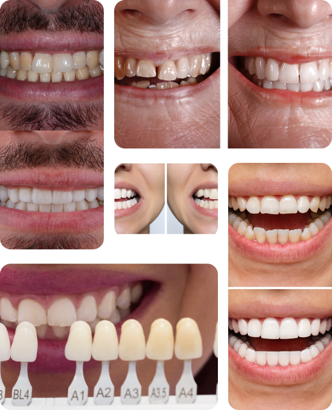 Composite Veneer