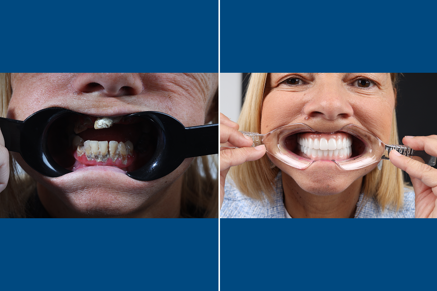 Dental Bridges 4