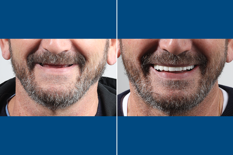 Dental Bridges 1