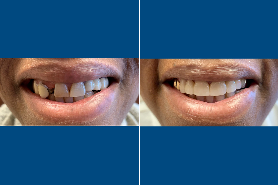 Dental Bridges 5