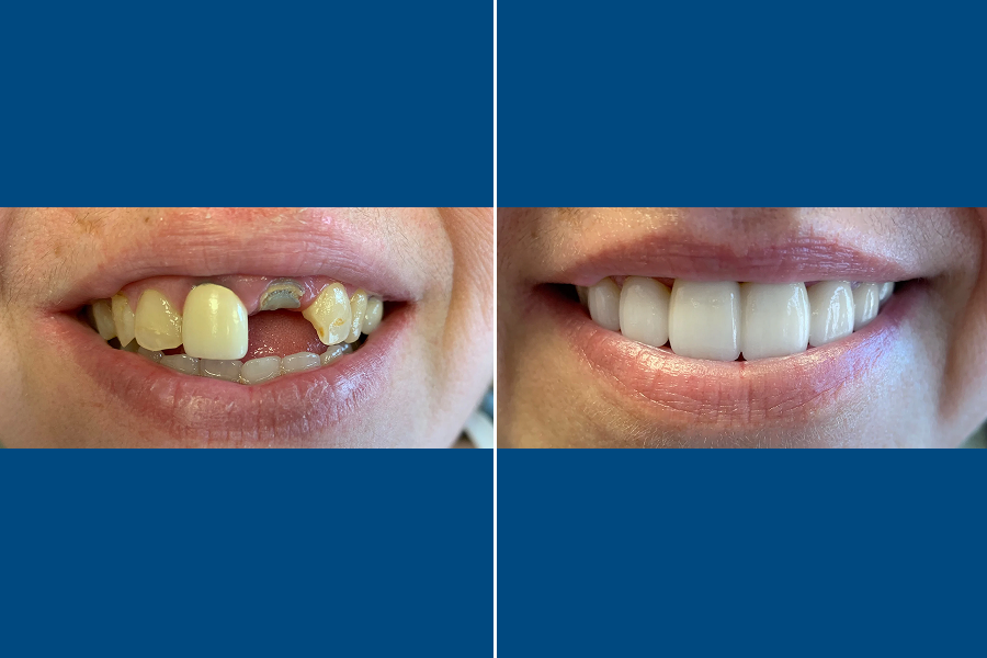 Dental Bridges 3