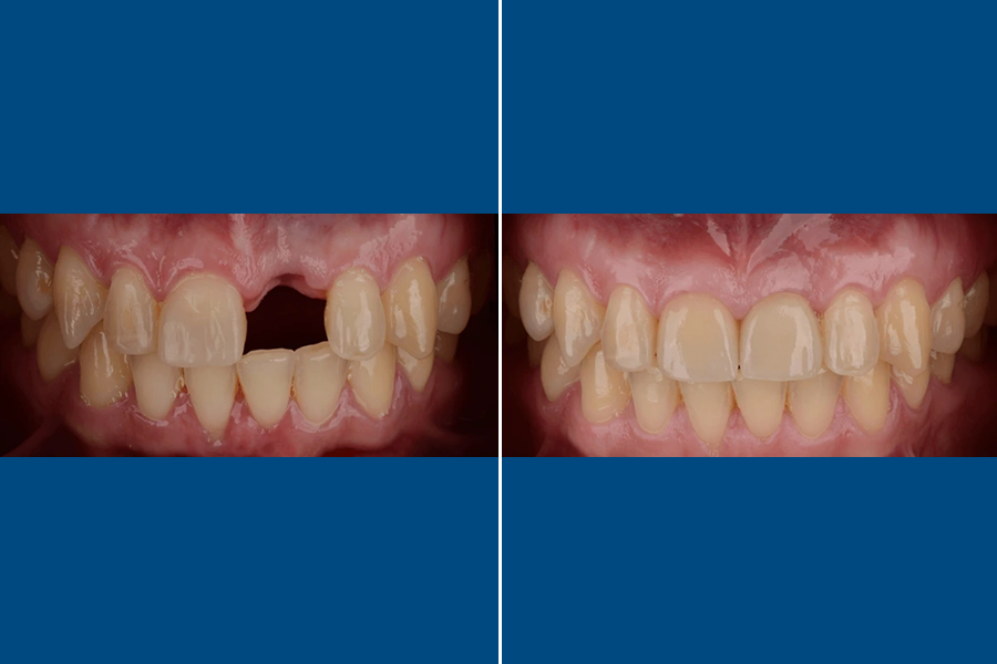 Dental Bridges 1