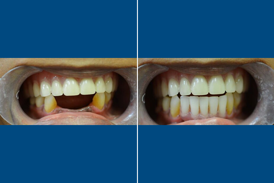 Dental Bridges 4