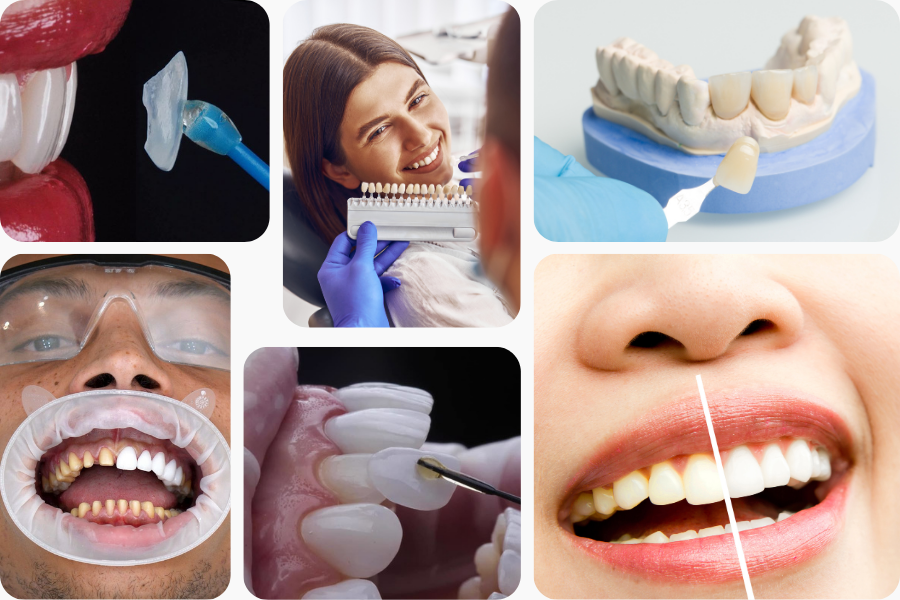 Dental Veneers