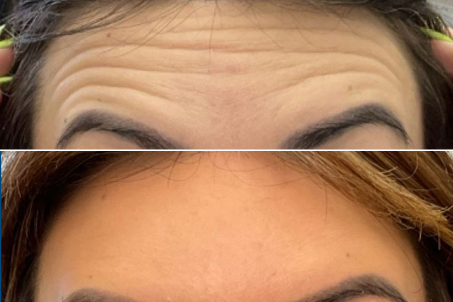 Dermal Fillers