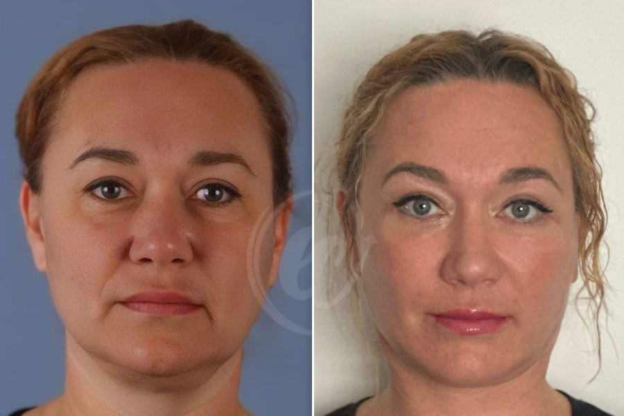 Dermal Fillers