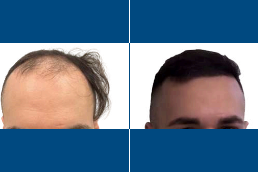 DHI Hair Transplantation: Revive Your Hairline